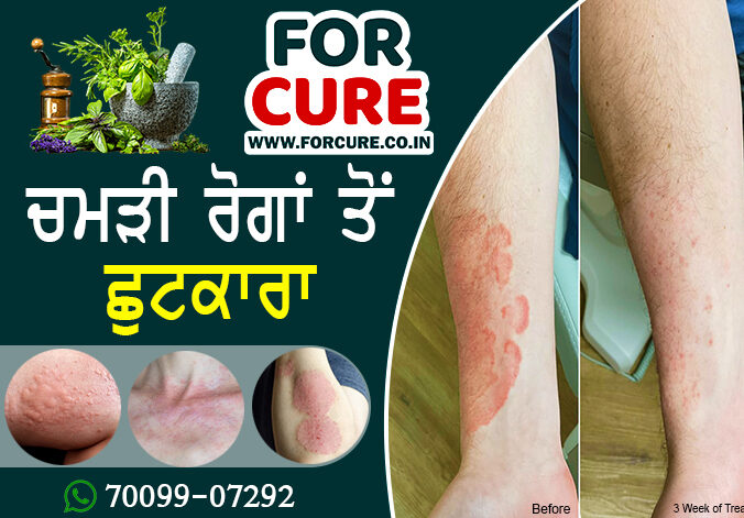 forcure medicine for itching, ringworm, and fungal infection | ਚਮੜੀ ਦੇ ਰੋਗਾਂ ਦੀ ਦਵਾਈ
